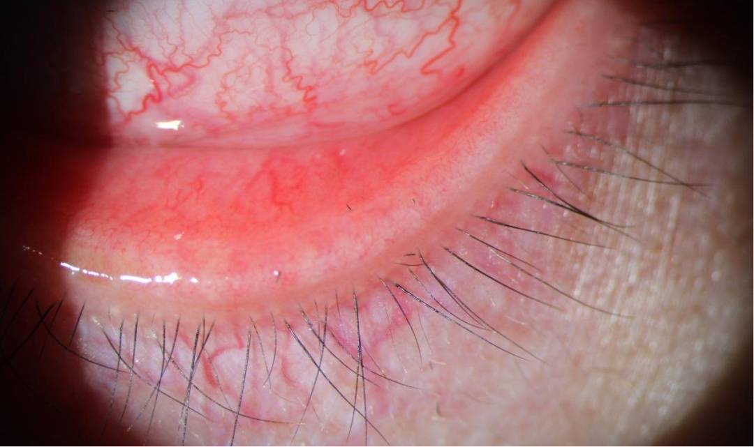 皇冠信用網开户_剧痛！一阵风吹过皇冠信用網开户，女子眼睛被扎进7根“黑刺”……近期多人中招