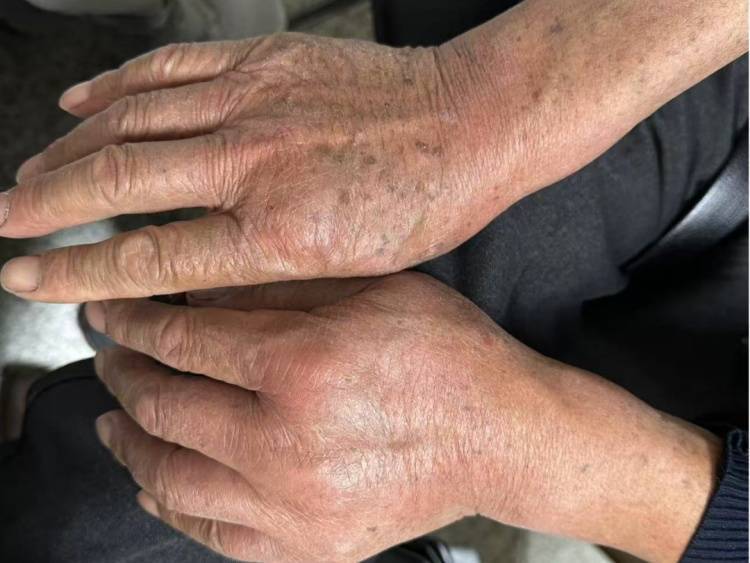 皇冠信用需要押金吗_68岁大伯被蚂蚁围攻送进抢救室！短短十几秒爬满全身皇冠信用需要押金吗，罪魁祸首竟是院子里的“宝贝”